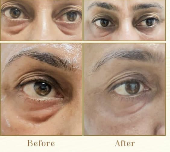 Under-eye tear-trough filler, before and after, performed by Dr. Lubna Rani Faysal