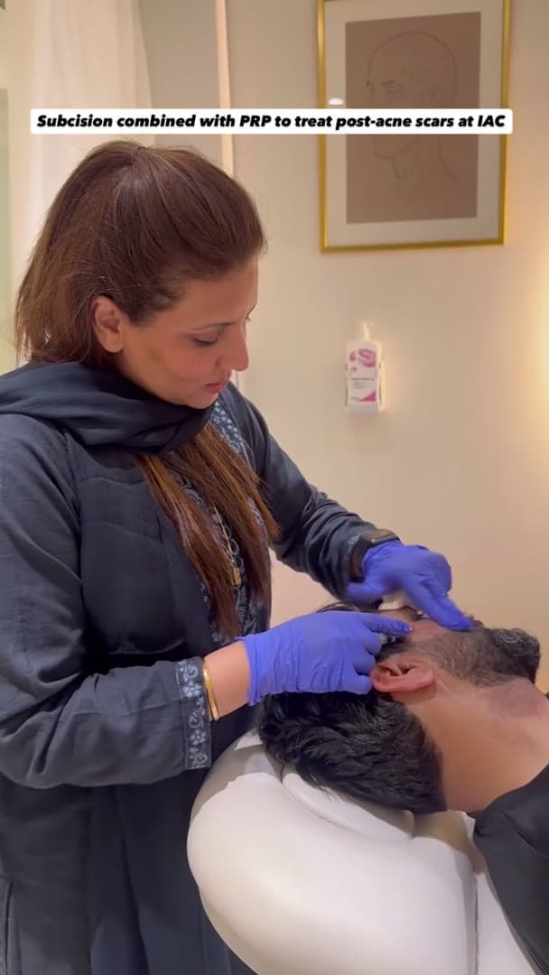 Subcision and PRP for acne scars