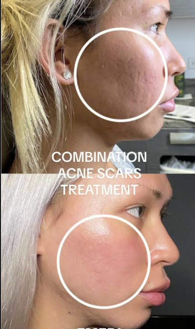 Clinical photograph showing acne scar treatment