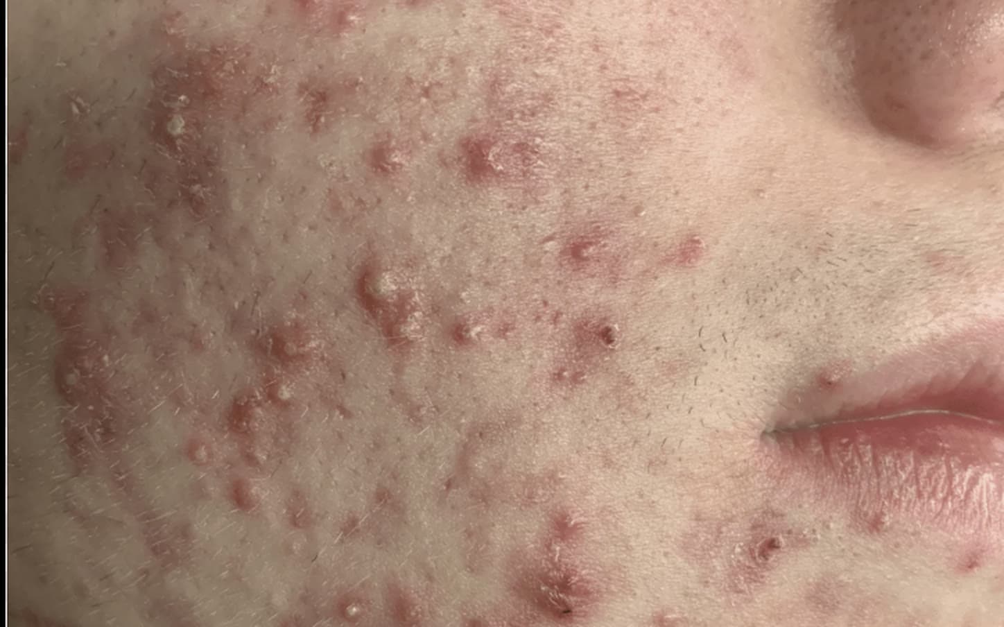 Clinical photograph showing acne
