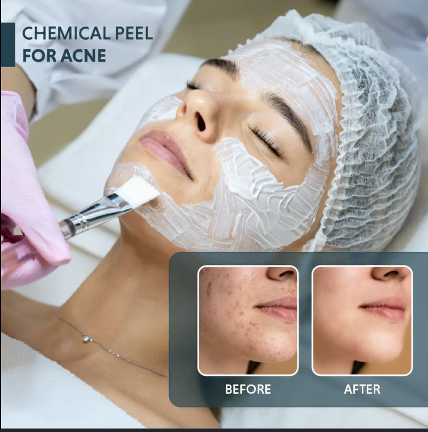 Clinical photograph showing chemical peeling