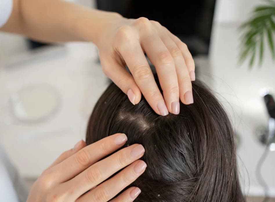 Clinical photograph showing dandruff