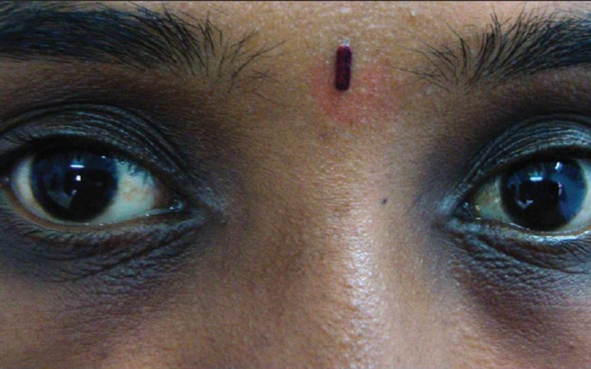 Clinical photograph showing dark circles