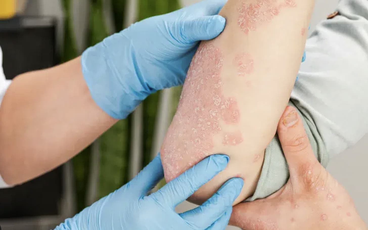 Clinical photograph showing eczema