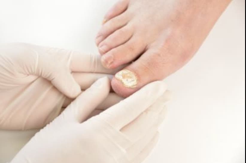 Clinical photograph showing fungal infections