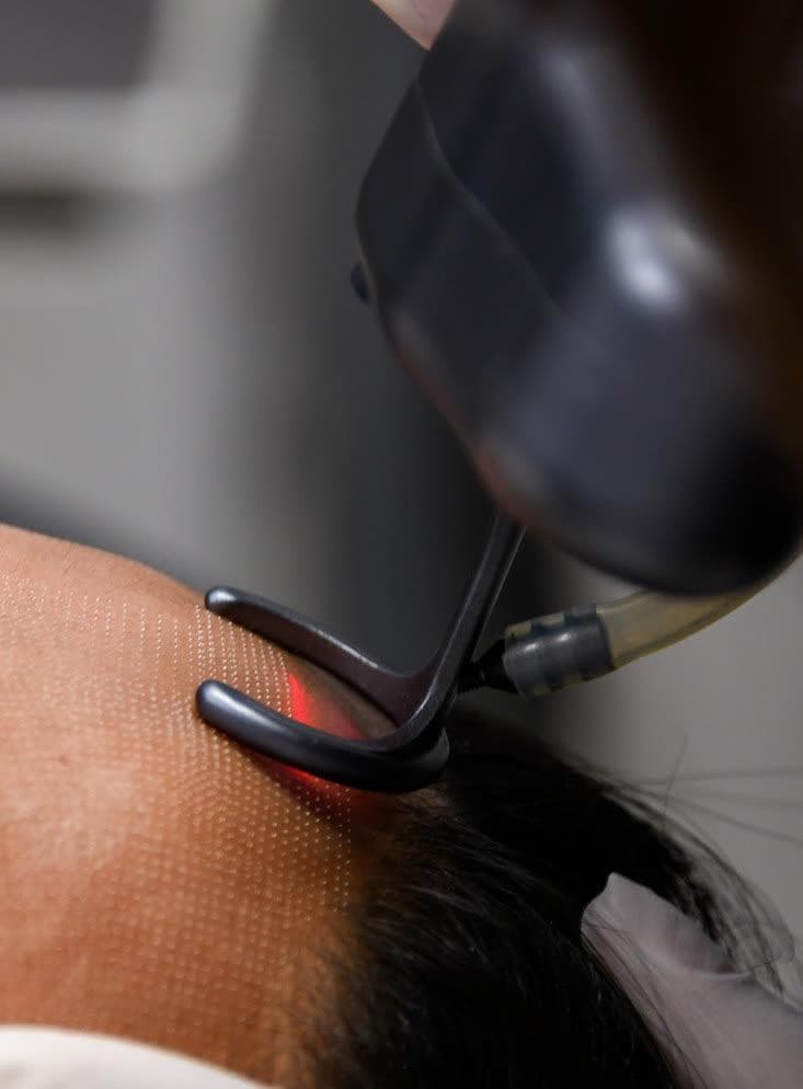 Clinical photograph showing laser hair removal