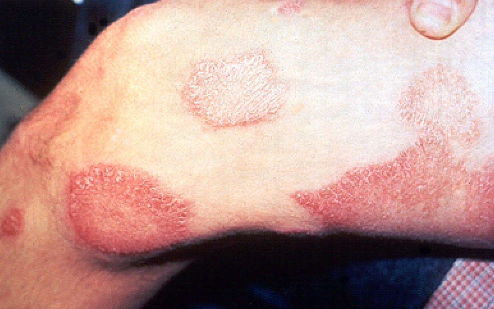 Clinical photograph showing leprosy