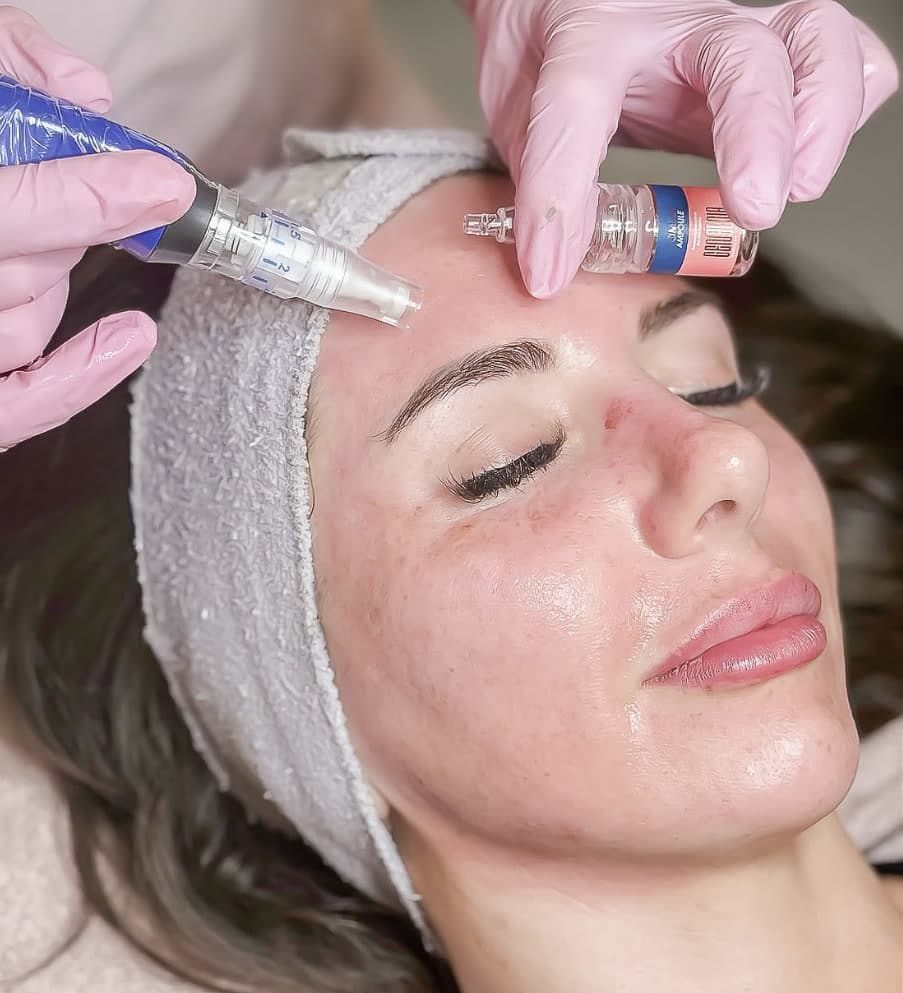 Clinical photograph showing microneedling