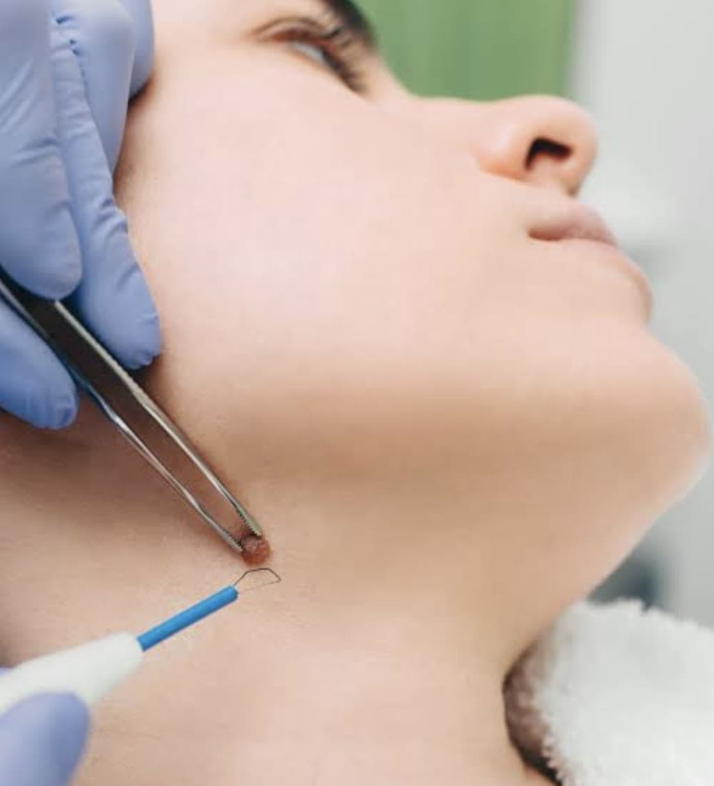 Clinical photograph showing mole & wart removal
