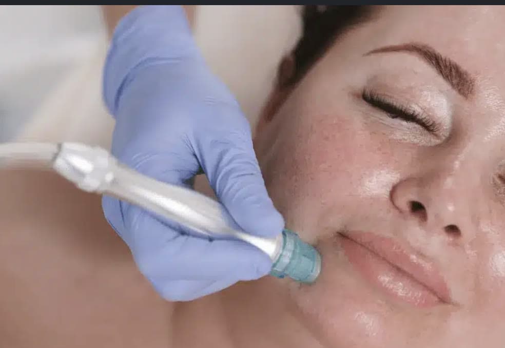 Clinical photograph showing open pores