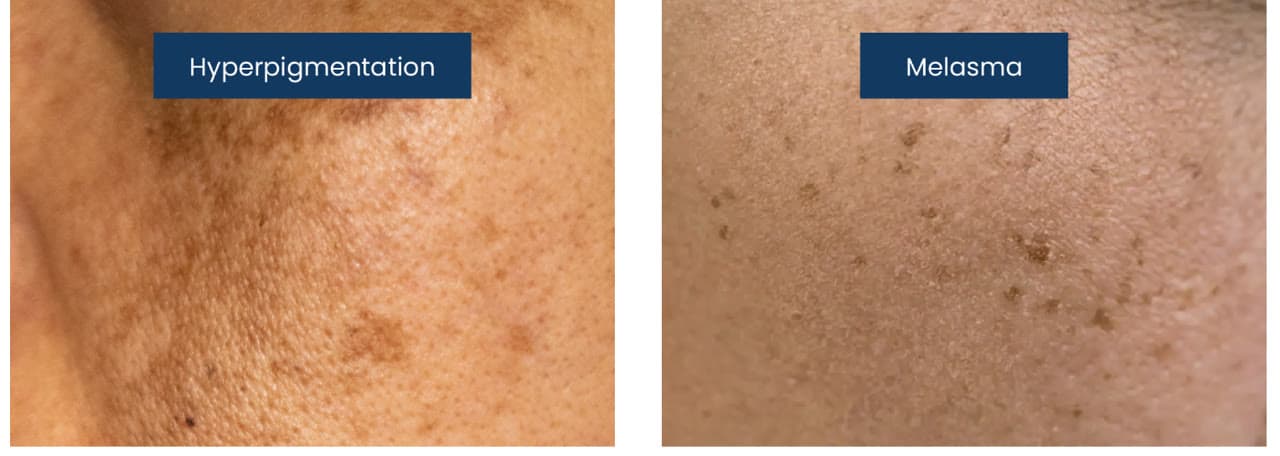 Clinical photograph showing pigmentation & melasma