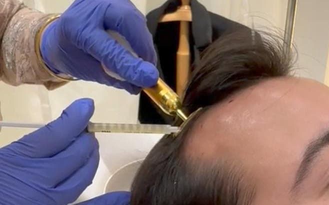Clinical photograph showing prp for skin