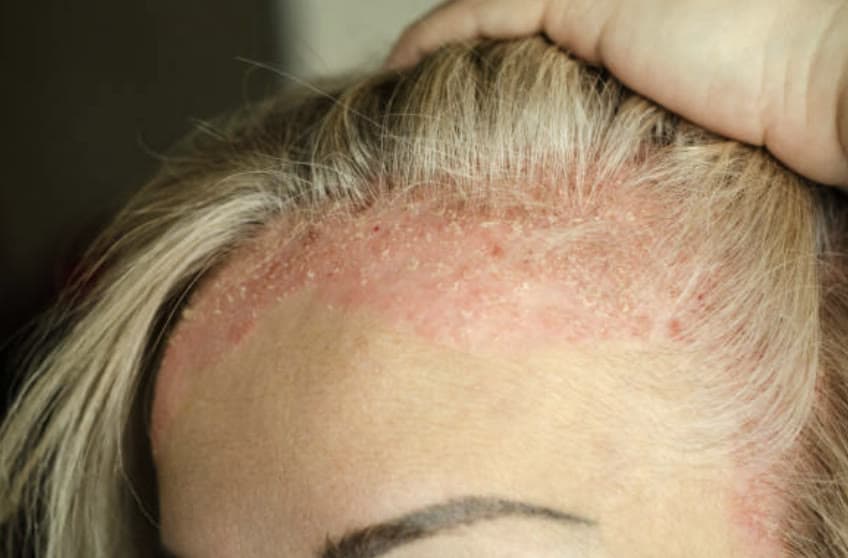 Clinical photograph showing psoriasis