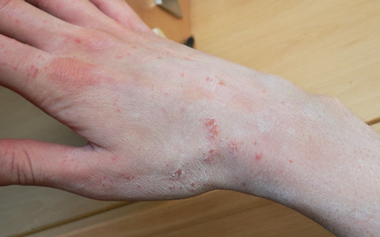 Clinical photograph showing scabies