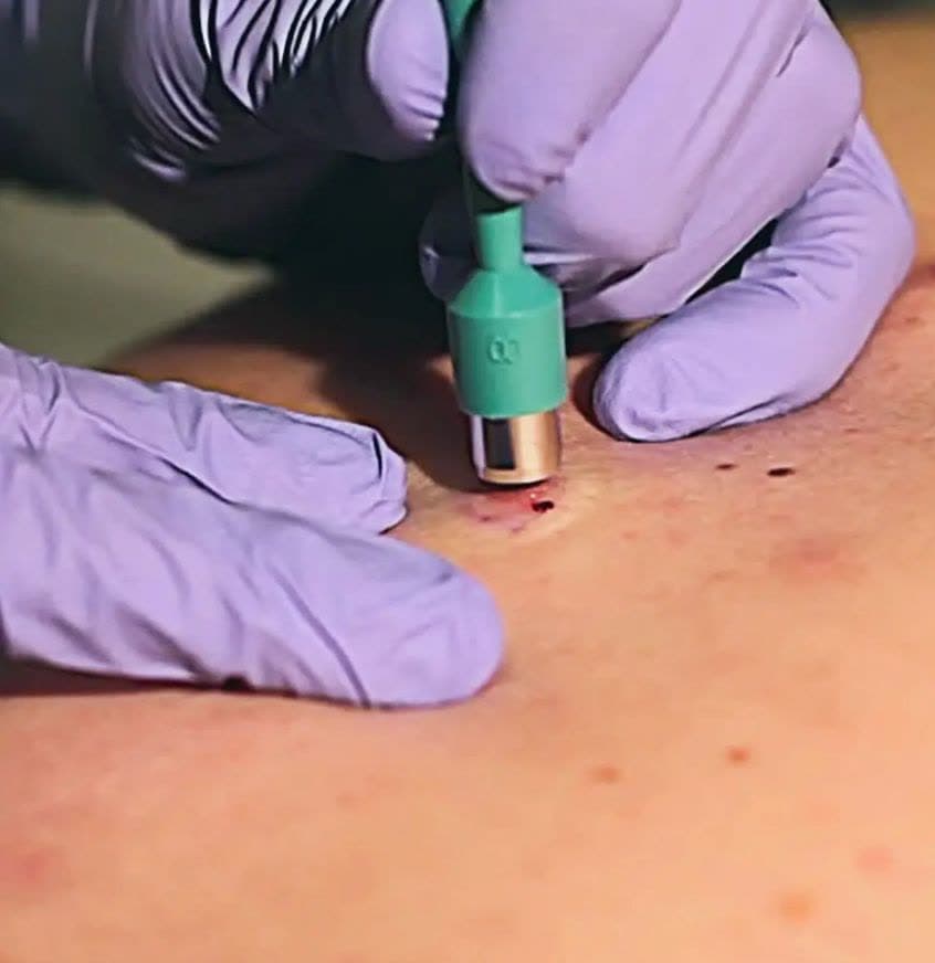Clinical photograph showing skin biopsy