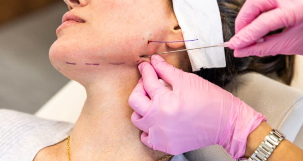 Clinical photograph showing thread lift