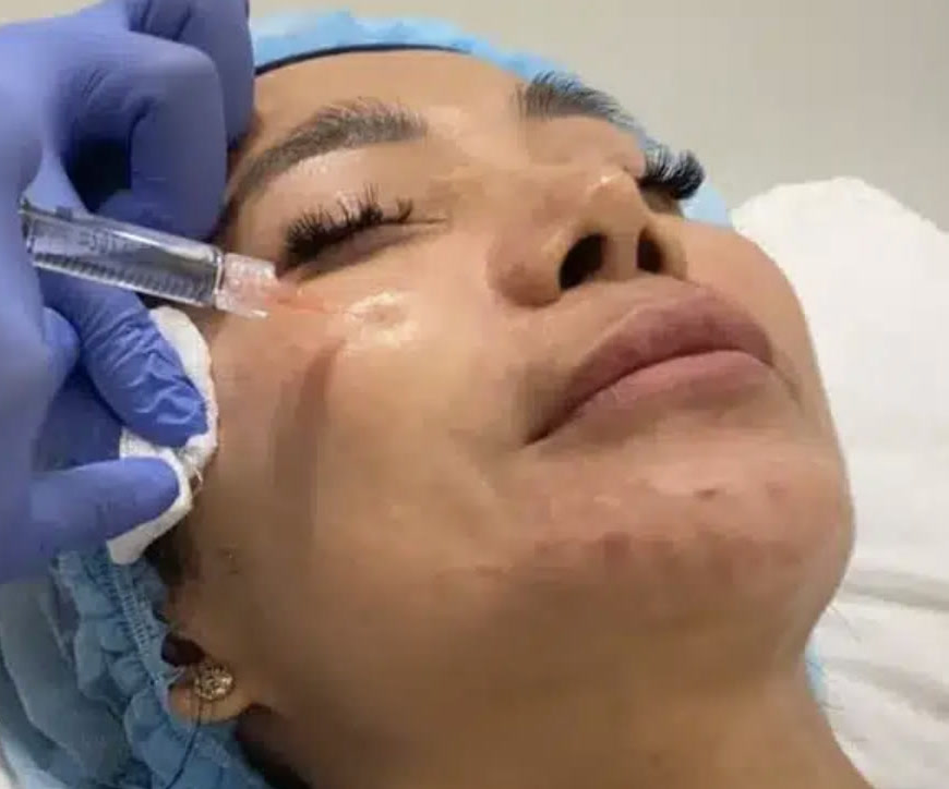 Microneedling